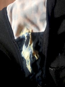 Corrimento fedido grosso  verde claro